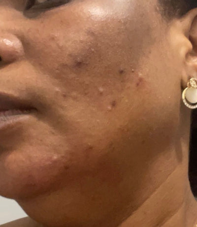 La crème Glutathione Glow chez Gladys Beauty : un soin anti-taches et anti-acné pour une peau éclatante !