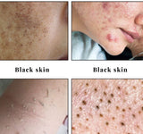 ⸻

CRÈME VISAGE Anti-acné
ÉCLAT & ÉCLAIRCISSANTE
VITAMINE C & E (infusée au glutathion & huile de citron & Curcuma,
Sans hydroquinone