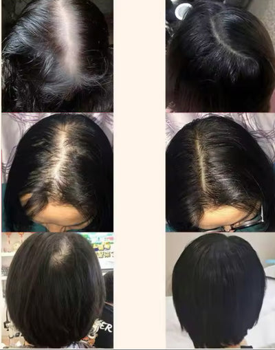 Produits anti-chute !Le secret pour avoir de longs cheveux.Chébé  Ensemble de croissance capillaire Glad’isBeauty.